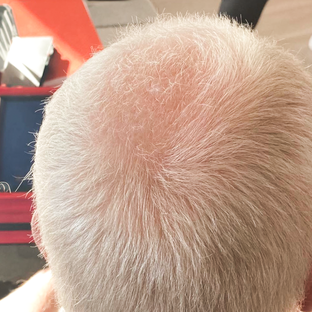 hair growth oil, hårvekst, miste håret, bedre hårvekst, raskere hårvekstens, stimulere hårvekst, øke hårvekst, mot hårtap, hårtap, hårtap menn, hårtap kvinner, håravfall, produkt hårtap, produkt hårvekst, produkt håravfall, hair growth serum, hair loss oil, hair loss serum, hårvekstprodukt, hårtap løsning, tykkere hår, prevent hair loss, beste produkt mot håravfall, tynt hår, hårolje, hårolje hårvekst, hårolje vekst, olje hårvekst, håravfall menn, håravfall kvinner, hair growth