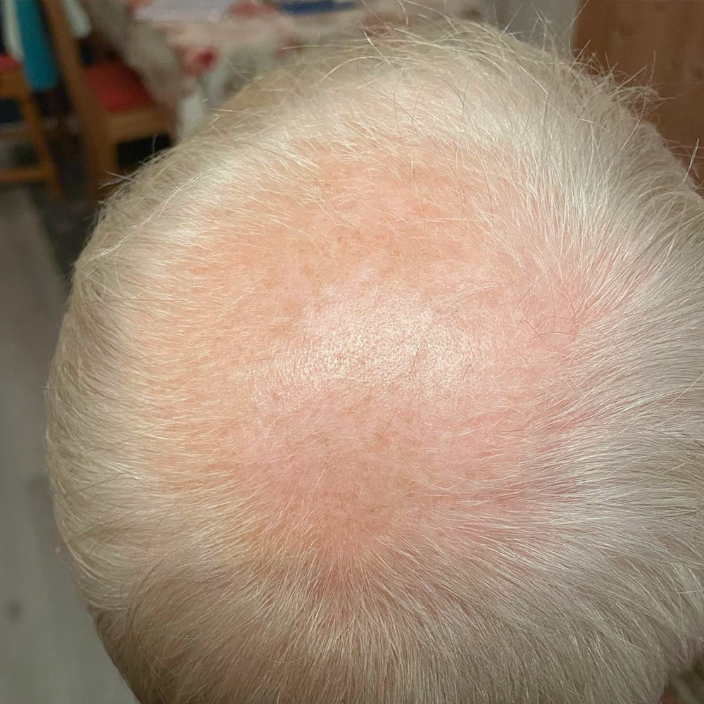 hair growth oil, hårvekst, miste håret, bedre hårvekst, raskere hårvekstens, stimulere hårvekst, øke hårvekst, mot hårtap, hårtap, hårtap menn, hårtap kvinner, håravfall, produkt hårtap, produkt hårvekst, produkt håravfall, hair growth serum, hair loss oil, hair loss serum, hårvekstprodukt, hårtap løsning, tykkere hår, prevent hair loss, beste produkt mot håravfall, tynt hår, hårolje, hårolje hårvekst, hårolje vekst, olje hårvekst, håravfall menn, håravfall kvinner, hair growth